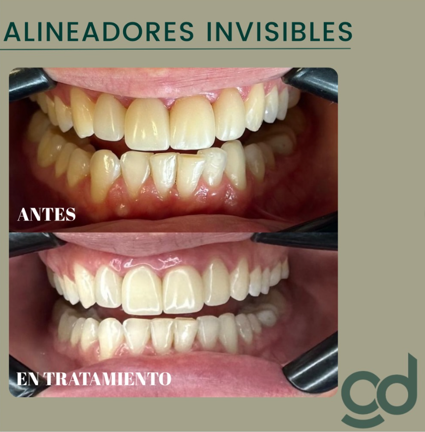 Caso clínico de alineadores invisibles antes y en tratamiento