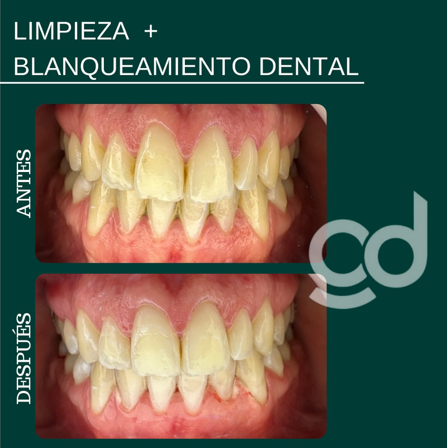 Tratamiento de Blanqueamiento Dental