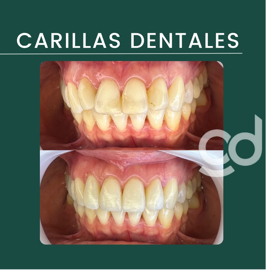 Caso clínico de carillas dentales