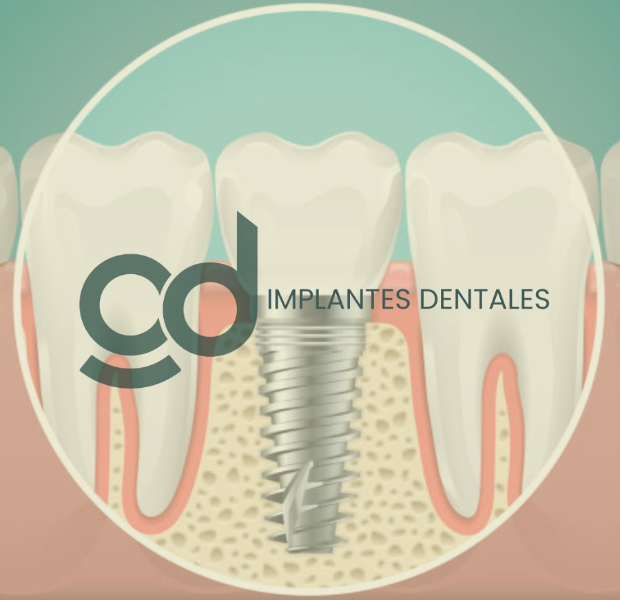 Tratamiento de Implantes Dentales